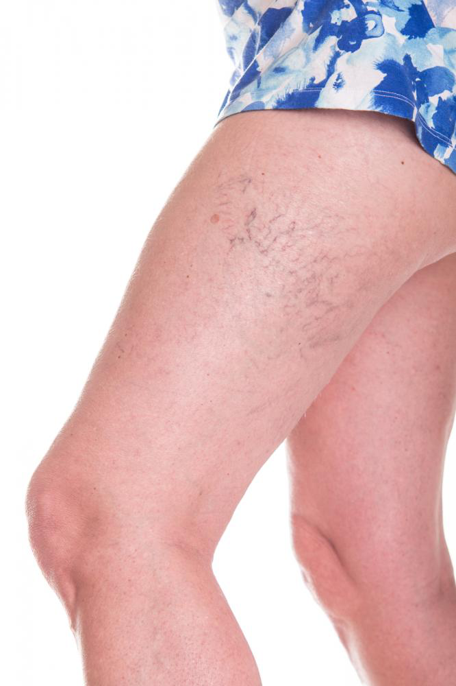 Image showing Sclerotherapy treatment for varicose veins