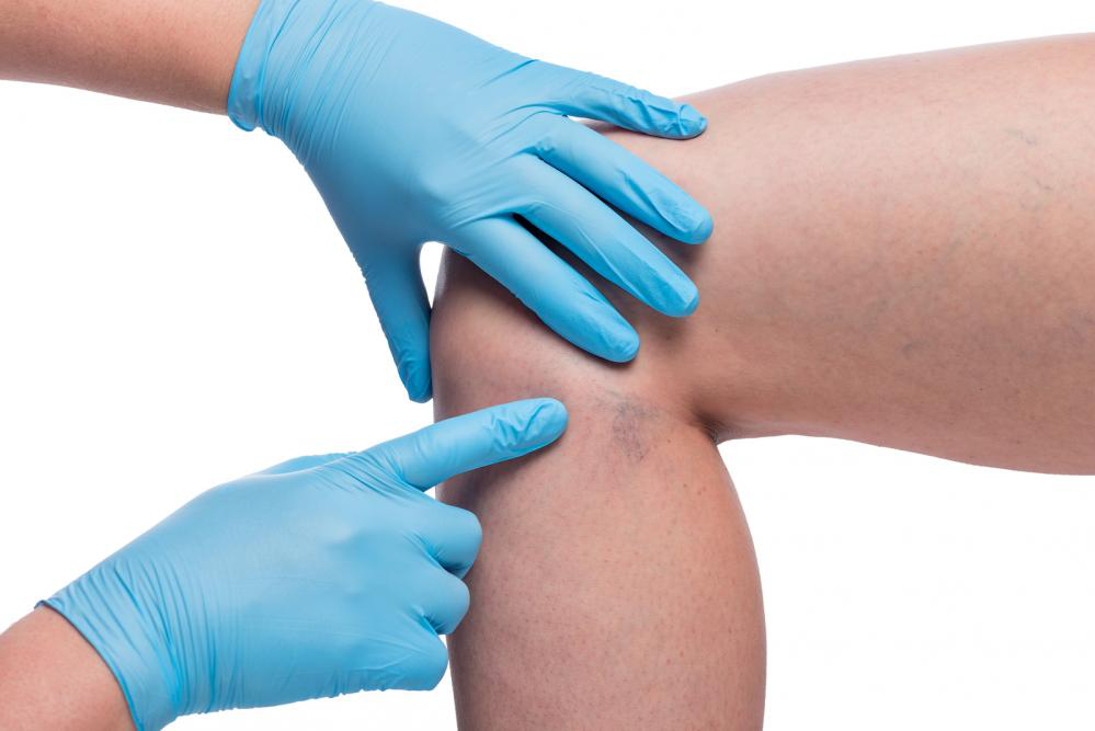 Image showing Sclerotherapy treatment for varicose