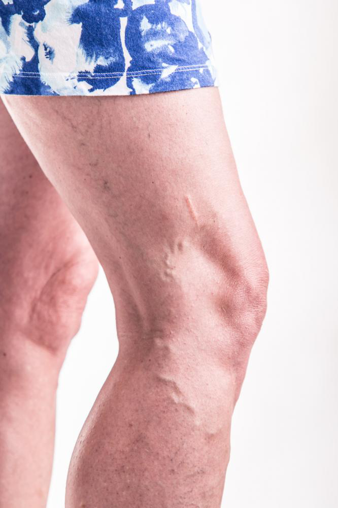 Image showing veins treatment