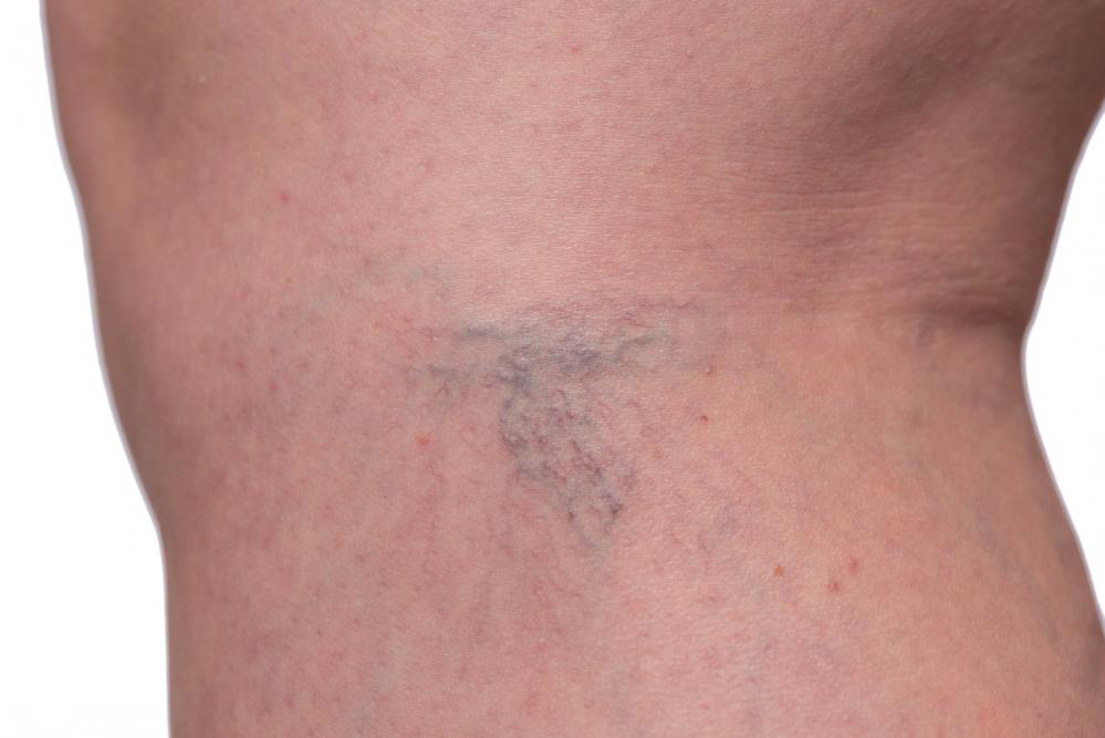 Image showing Sclerotherapy