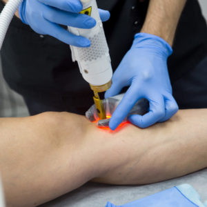 Doctors doing an operation on a vein in a phlebology clinic