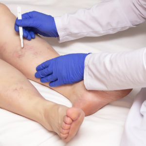 Doctor vascular surgeon holds a scalpel near the legs of a woman with a disease of varicose veins of the lower extremities. The concept of treating varicose veins with surgery, healthcare