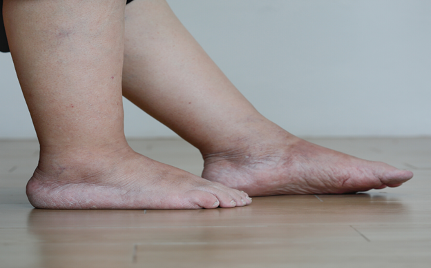 Leg Swelling Disease